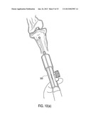 SUTURE TENSIONING DEVICE diagram and image