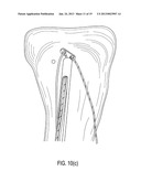 SUTURE TENSIONING DEVICE diagram and image