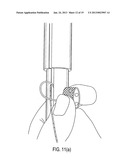 SUTURE TENSIONING DEVICE diagram and image