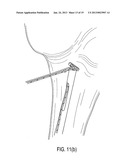 SUTURE TENSIONING DEVICE diagram and image