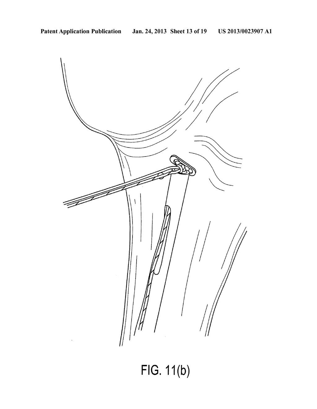 SUTURE TENSIONING DEVICE - diagram, schematic, and image 14
