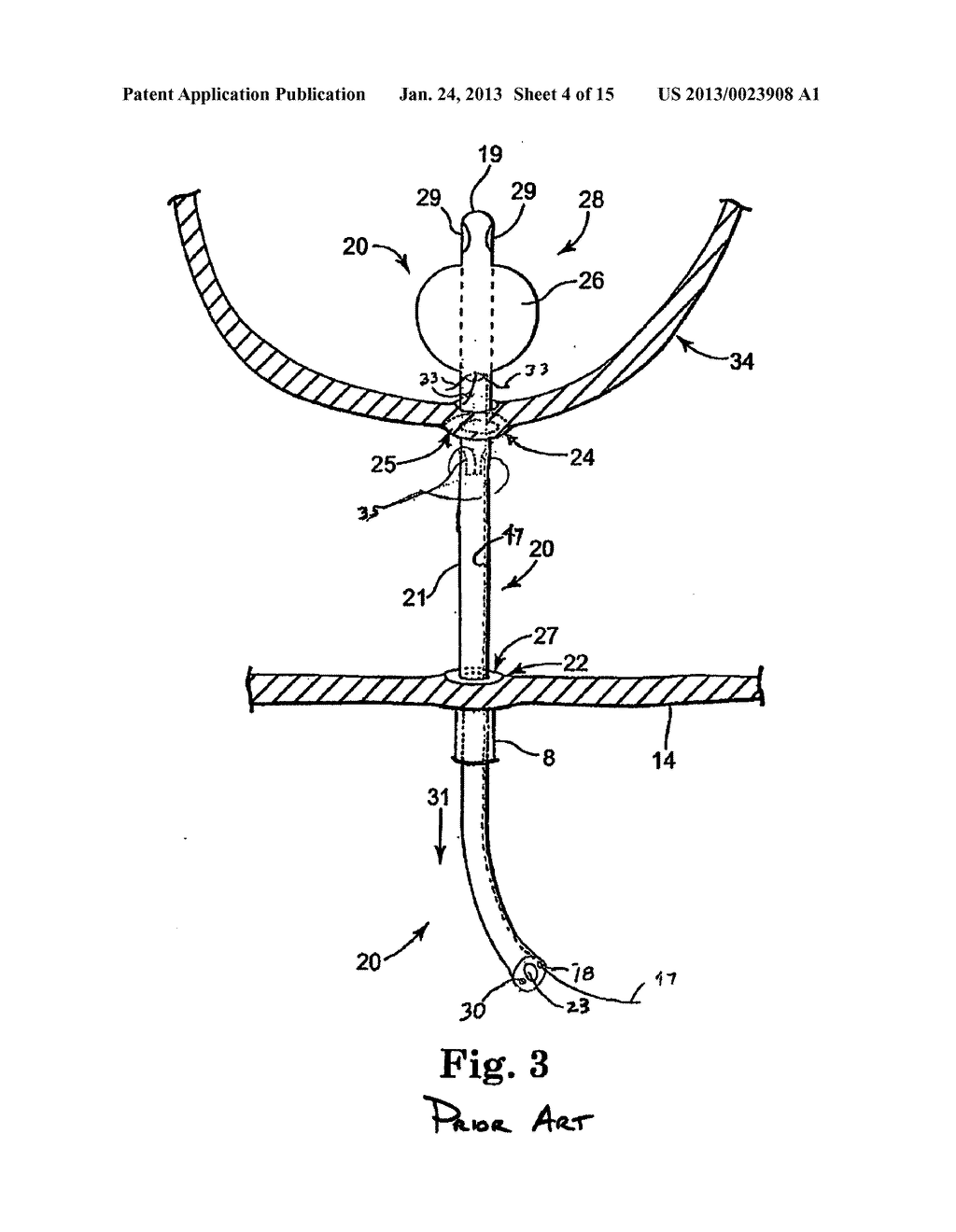 ANASTOMOSIS DEVICE AND METHOD - diagram, schematic, and image 05