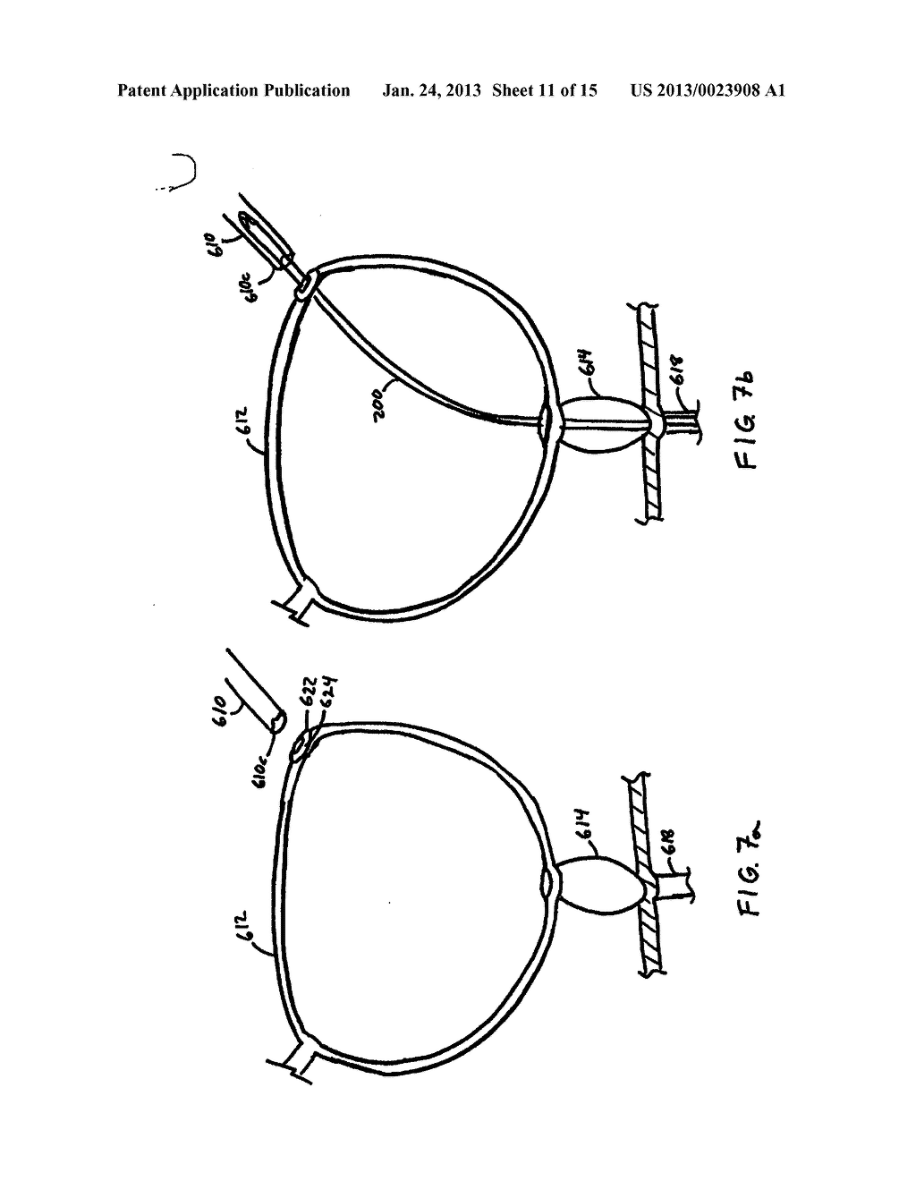 ANASTOMOSIS DEVICE AND METHOD - diagram, schematic, and image 12