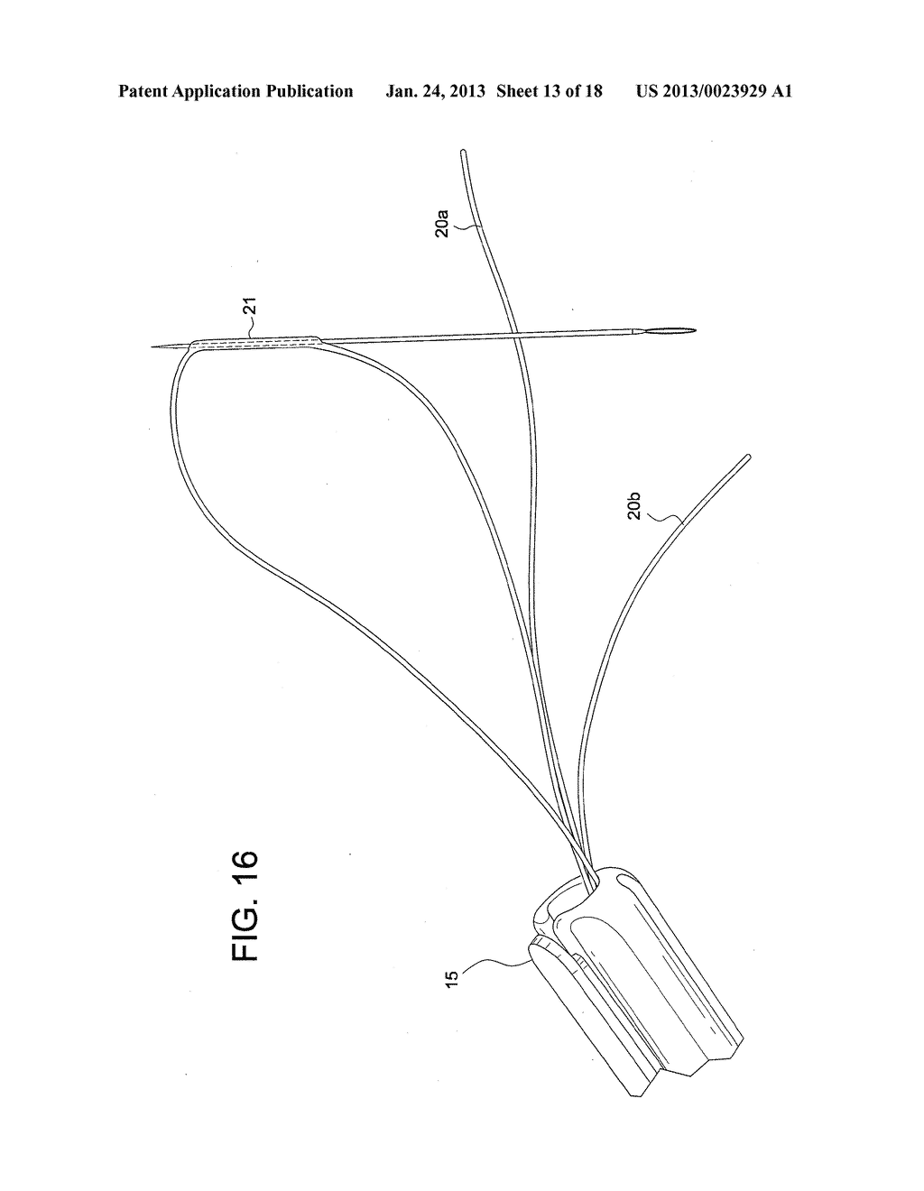 TENSIONABLE KNOTLESS ACROMIOCLAVICULAR REPAIRS AND CONSTRUCTS - diagram, schematic, and image 14