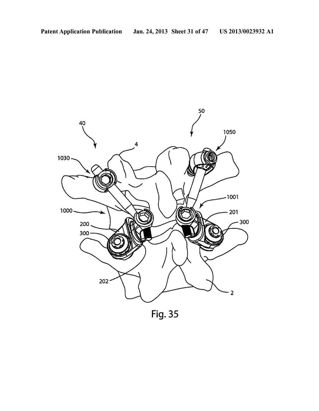 System and Method for Facet Hoint Replacement - diagram, schematic, and image 32