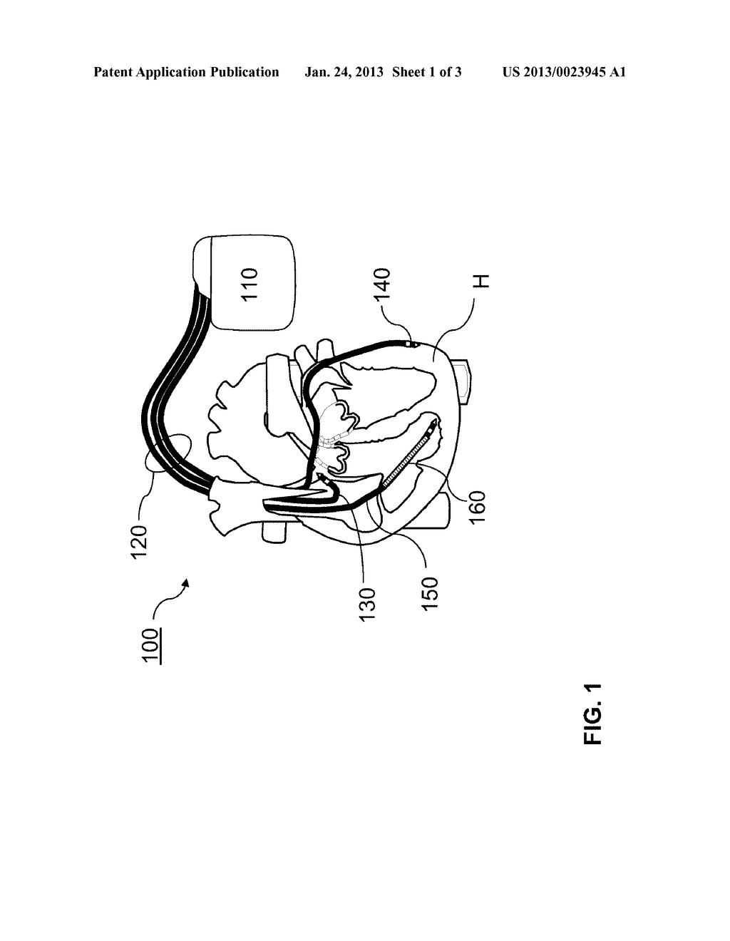 IMPLANTABLE DEFIBRILLATION ARRANGEMENT AND ELECTRODE LEAD - diagram, schematic, and image 02