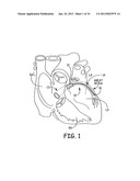 INTRAVASCULAR MEDICAL DEVICE WITH ADVANCABLE ELECTRODE diagram and image