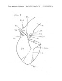 Oval Aortic Valve diagram and image