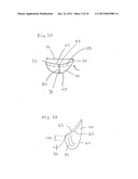 Oval Aortic Valve diagram and image