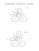 Oval Aortic Valve diagram and image