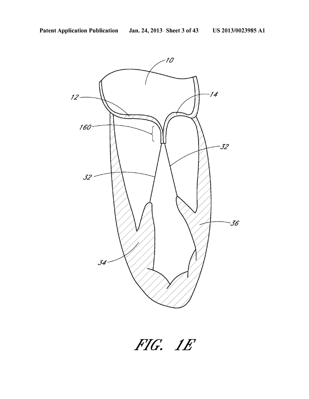 DEVICE, SYSTEM, AND METHOD FOR TRANSCATHETER TREATMENT OF VALVE     REGURGITATION - diagram, schematic, and image 04