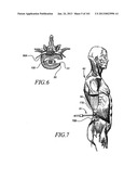 Minimally invasive apparatus to manipulate and revitalize spinal column     disc diagram and image