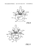 Minimally invasive apparatus to manipulate and revitalize spinal column     disc diagram and image