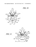 Minimally invasive apparatus to manipulate and revitalize spinal column     disc diagram and image