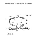 Minimally invasive apparatus to manipulate and revitalize spinal column     disc diagram and image