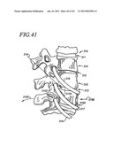 Minimally invasive apparatus to manipulate and revitalize spinal column     disc diagram and image