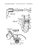 Minimally invasive apparatus to manipulate and revitalize spinal column     disc diagram and image