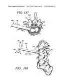 Minimally invasive apparatus to manipulate and revitalize spinal column     disc diagram and image