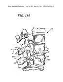 Minimally invasive apparatus to manipulate and revitalize spinal column     disc diagram and image