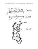 Minimally invasive apparatus to manipulate and revitalize spinal column     disc diagram and image