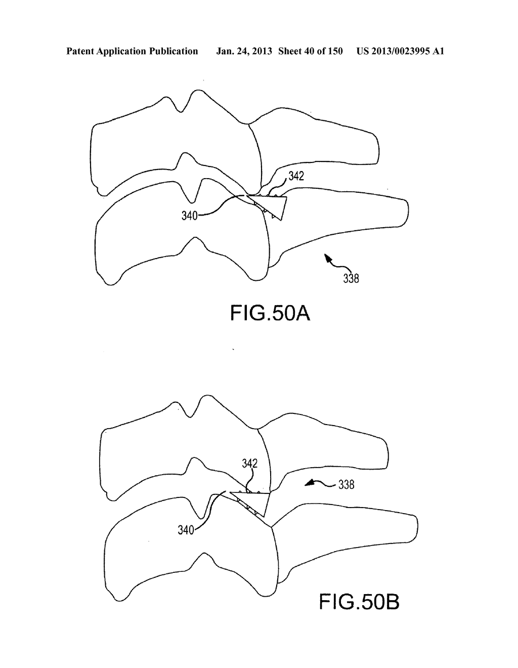 VERTEBRAL JOINT IMPLANTS AND DELIVERY TOOLS - diagram, schematic, and image 41