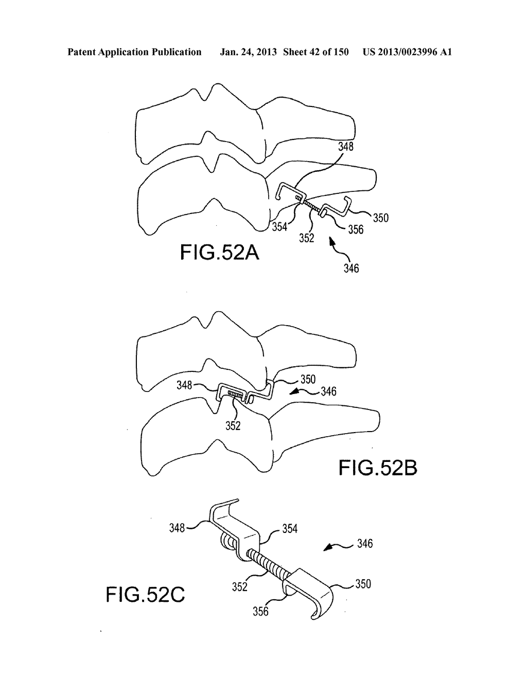 VERTEBRAL JOINT IMPLANTS AND DELIVERY TOOLS - diagram, schematic, and image 43