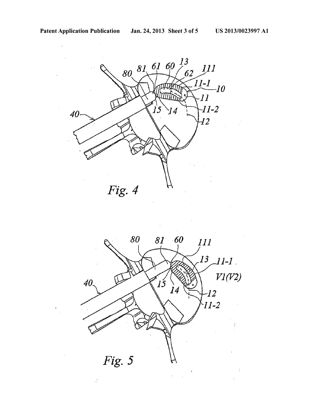 SYSTEM FOR REPLACING AN INTERVERTEBRAL DISC - diagram, schematic, and image 04