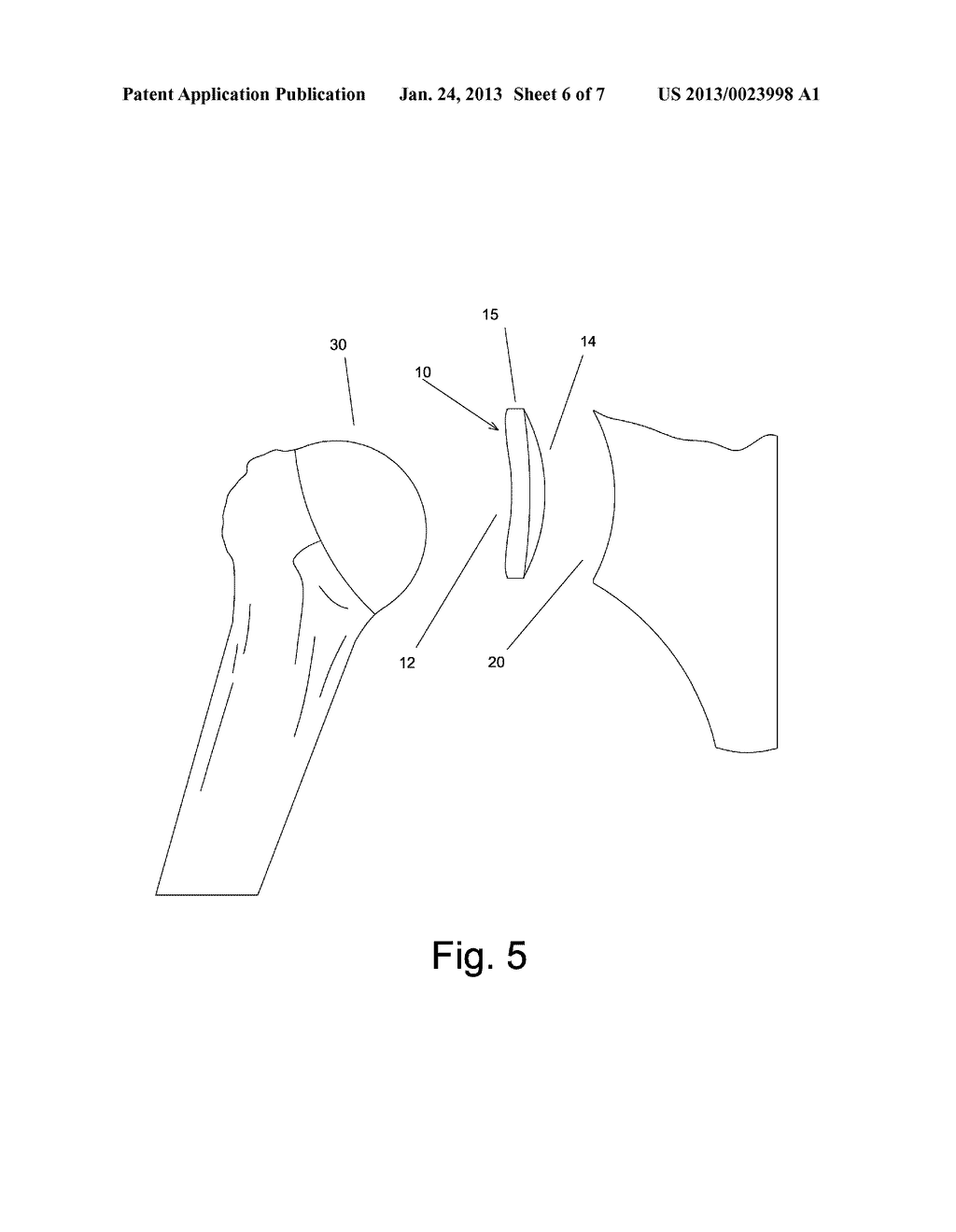 SHOULDER INTER-SPACER COMPONENT AND SURGICAL METHOD OF IMPLANTATION - diagram, schematic, and image 07