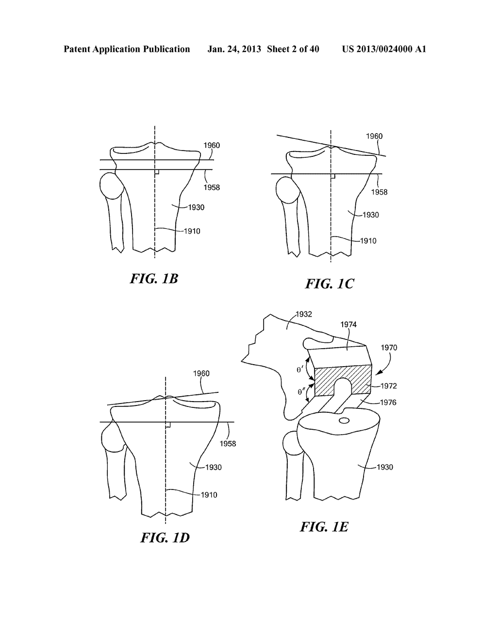 Patient Selectable Joint Arthroplasty Devices and Surgical Tools - diagram, schematic, and image 03