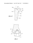 Patient Selectable Joint Arthroplasty Devices and Surgical Tools diagram and image