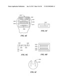 Patient Selectable Joint Arthroplasty Devices and Surgical Tools diagram and image