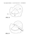 Patient Selectable Joint Arthroplasty Devices and Surgical Tools diagram and image