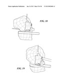 Patient Selectable Joint Arthroplasty Devices and Surgical Tools diagram and image