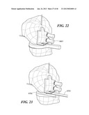 Patient Selectable Joint Arthroplasty Devices and Surgical Tools diagram and image