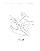 Patient Selectable Joint Arthroplasty Devices and Surgical Tools diagram and image