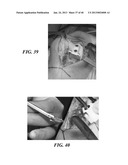 Patient Selectable Joint Arthroplasty Devices and Surgical Tools diagram and image