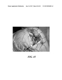 Patient Selectable Joint Arthroplasty Devices and Surgical Tools diagram and image