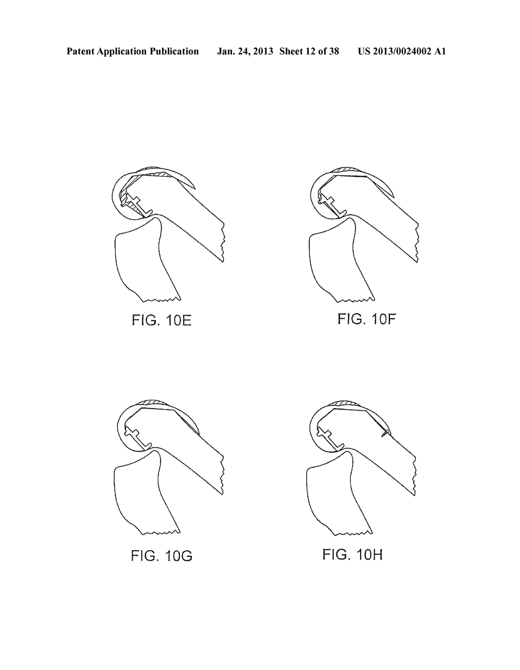 SYSTEMS AND METHODS FOR PROVIDING DEEPER KNEE FLEXION CAPABILITIES FOR     KNEE PROSTHESIS PATIENTS - diagram, schematic, and image 13