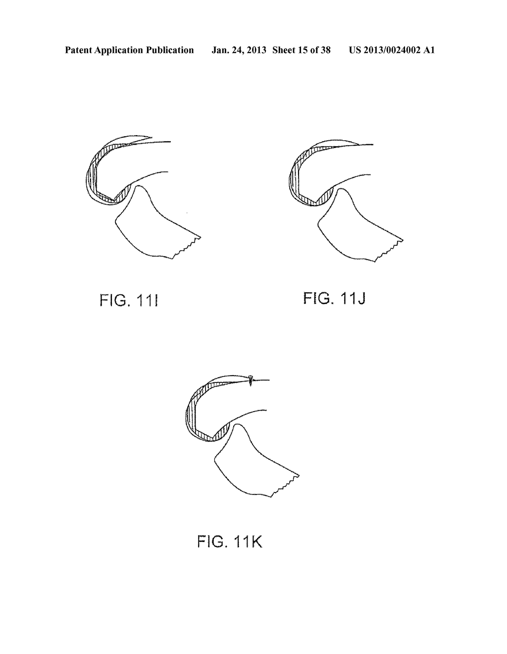 SYSTEMS AND METHODS FOR PROVIDING DEEPER KNEE FLEXION CAPABILITIES FOR     KNEE PROSTHESIS PATIENTS - diagram, schematic, and image 16