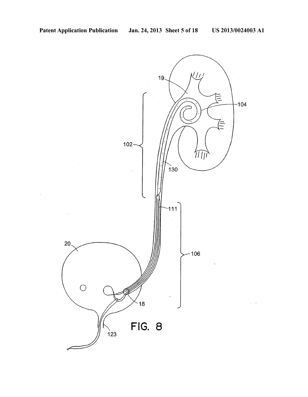 URETERAL STENT FOR IMPROVED PATIENT COMFORT - diagram, schematic, and image 06