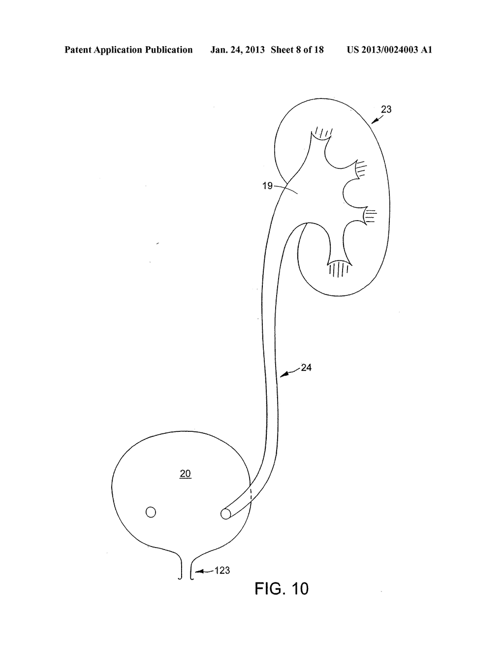 URETERAL STENT FOR IMPROVED PATIENT COMFORT - diagram, schematic, and image 09