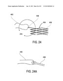 METHODS AND DEVICES FOR DEPLOYMENT INTO A LUMEN diagram and image