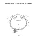 Conformable Therapeutic Shield for Vision and Pain diagram and image