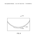 Conformable Therapeutic Shield for Vision and Pain diagram and image