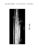 Conformable Therapeutic Shield for Vision and Pain diagram and image