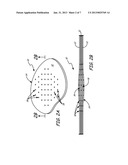 BOND AND STITCH REPAIR FOR DELAMINATED COMPOSITE diagram and image