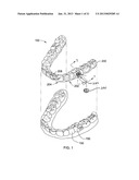 ORTHODONTIC ATTACHMENT DEVICE SYSTEMS AND METHODS diagram and image