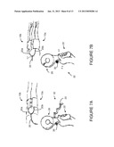 TOURNIQUET FOR MAGNETIC RESONANCE ANGIOGRAPHY, AND METHOD OF USING SAME diagram and image