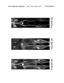 TOURNIQUET FOR MAGNETIC RESONANCE ANGIOGRAPHY, AND METHOD OF USING SAME diagram and image