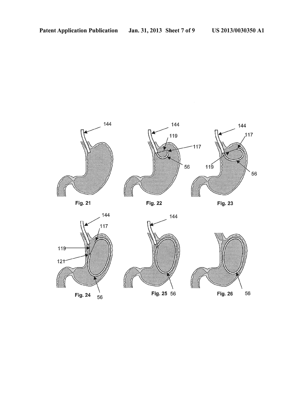 Devices and Methods for Anchoring an Endoluminal Sleeve in the GI Tract - diagram, schematic, and image 08